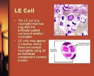 Systemic Lupus Erythematosus PowerPoint Presentation