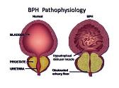 LUTS BPH Carcinoma Prostate