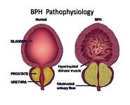 LUTS BPH Carcinoma Prostate PowerPoint Presentation