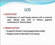 Breast Carcinoma PowerPoint Presentation