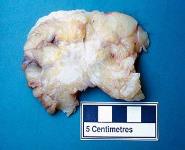 Histopathology and staging of breast cancer PowerPoint Presentation