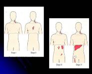 About Non Hodgkins lymphoma (NHL) PowerPoint Presentation