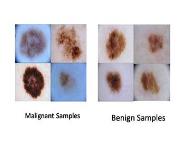 Lightweight Deep Learning on Smart Device for Early Detection of Skin Cancer PowerPoint Presentation