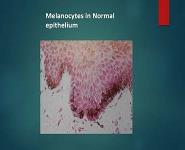 Disorders of Melanocytes Melanoma PowerPoint Presentation Notes