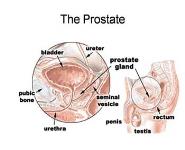 Prostate Cancer: Diagnosis and Prevention PowerPoint Presentation