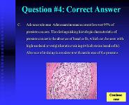 Cancer Survivorship - Prostate Cancer Risks and Treatments PowerPoint Presentation Notes