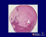 Neoplasia II - Invasion Metastasis and Effects of Tumours PowerPoint Presentation Notes