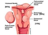 UTERINE FIBROIDS (LEIOMYOMATAS)