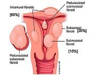 UTERINE FIBROIDS (LEIOMYOMATAS) PowerPoint Presentation