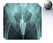 CARCINOMA CERVIX PowerPoint Presentation Notes