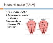 Abnormal Uterine Bleeding PowerPoint Presentation