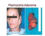 Salivary Gland Pathology PowerPoint Presentation Notes