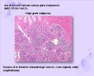Adenoid Cystic Carcinoma AdCC - Cylindroma PowerPoint Presentation