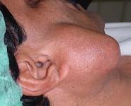 Salivary Gland Neoplasm PowerPoint Presentation