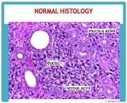 Diseases of salivary gland PowerPoint Presentation