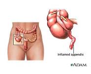 Appendicitis PowerPoint Presentation Notes