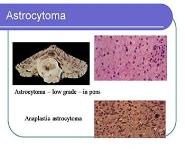 Brain tumors PowerPoint Presentation Notes