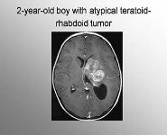 Central nervous system malignancies PowerPoint Presentation