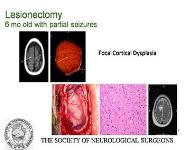 Pediatric Neurosurgery PowerPoint Presentation Notes