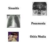 Immunodeficiency Diseases PowerPoint Presentation