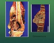 Malignant Bone Tumors PowerPoint Presentation Notes