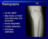 Bone and Soft Tissue Sarcomas PowerPoint Presentation Notes