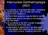 A and V Patterns and Other Types of Strabismus