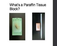 Next Generation Sequencing Approach to Desmoid Tumors PowerPoint Presentation