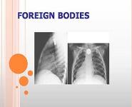 Caustic Ingestion and Foreign Bodies of the Aerodigestive Tract PowerPoint Presentation Notes