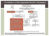 Barretts Esophagus