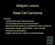 Eyelid Cancer and Reconstruction PowerPoint Presentation