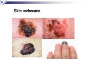 Modern therapy in oncology - metastatic melanoma