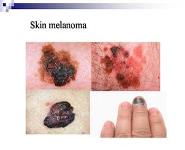 Modern therapy in oncology - metastatic melanoma PowerPoint Presentation