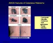 Childhood Melanoma PowerPoint Presentation Notes