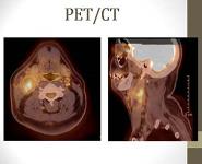 Carcinoma of Unknown Primary: The Role of Transoral Robotic Surgery PowerPoint Presentation