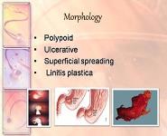 Gastric Carcinoma PowerPoint Presentation Notes