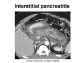Acute and Chronic Pancreatitis