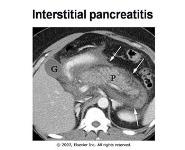 Acute and Chronic Pancreatitis PowerPoint Presentation Notes
