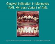 Acute Myeloid Leukemia and Acute Complications PowerPoint Presentation