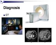 Hepatocellular carcinoma PowerPoint Presentation