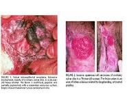 Carcinoma of the Vulva PowerPoint Presentation Notes