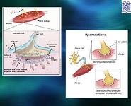 Myastenia gravis PowerPoint Presentation