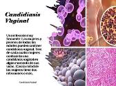 Candidiasis Vaginal