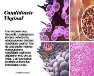 Candidiasis Vaginal PowerPoint Presentation