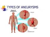 Endovascular AAA Repair