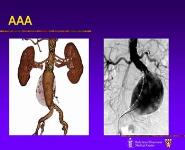 Screening Guidelines and Treatment Options for Abdominal Aortic Aneurysms PowerPoint Presentation