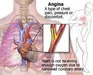 Angina Pectoris PowerPoint Presentation Notes
