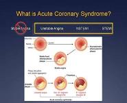 Acute Coronary Syndrome PowerPoint Presentation Notes