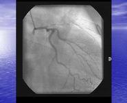 Coronary Heart Disease in Women PowerPoint Presentation