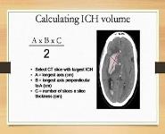Intracerebral Hemorrhage (ICH) PowerPoint Presentation